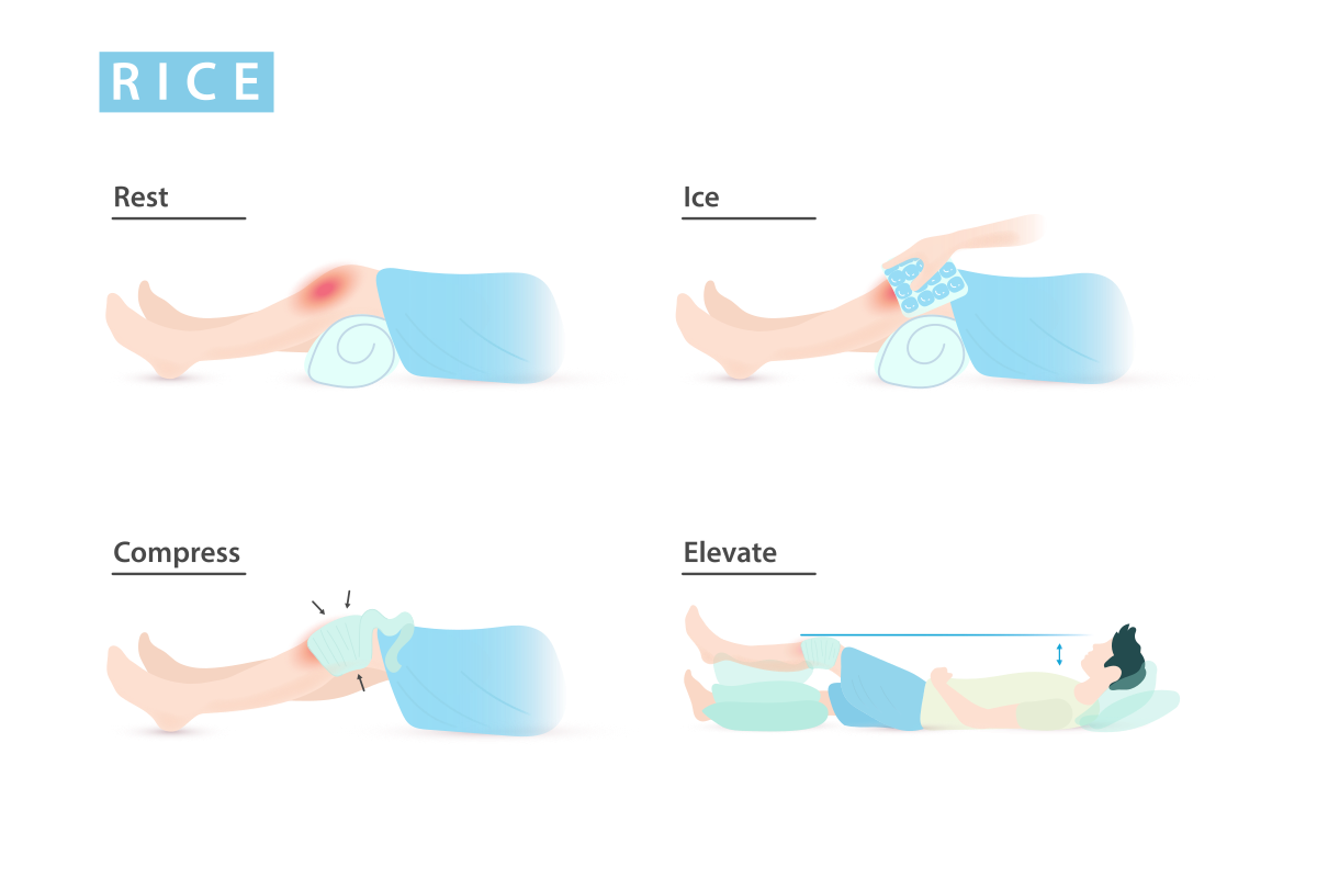 R.I.C.E. method for treating sprains