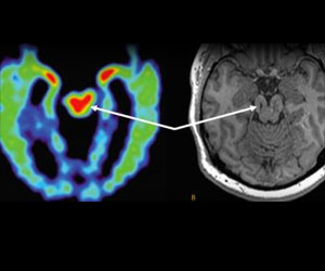 A brain scan showing the damage caused by chronic traumatic encephalopathy.