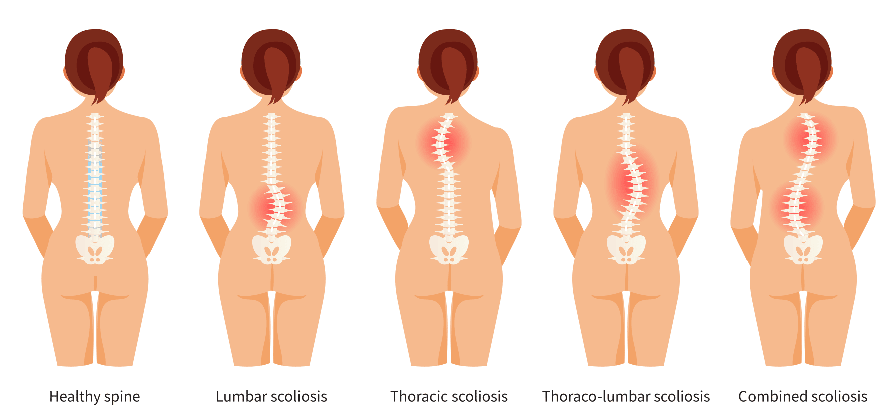 diagram showing a normal spine and a spine with scoliosis