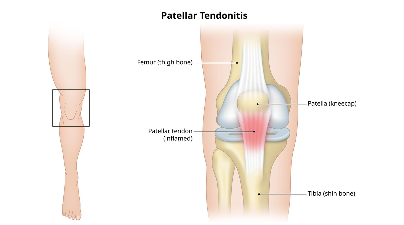 Patellar Tendonitis
