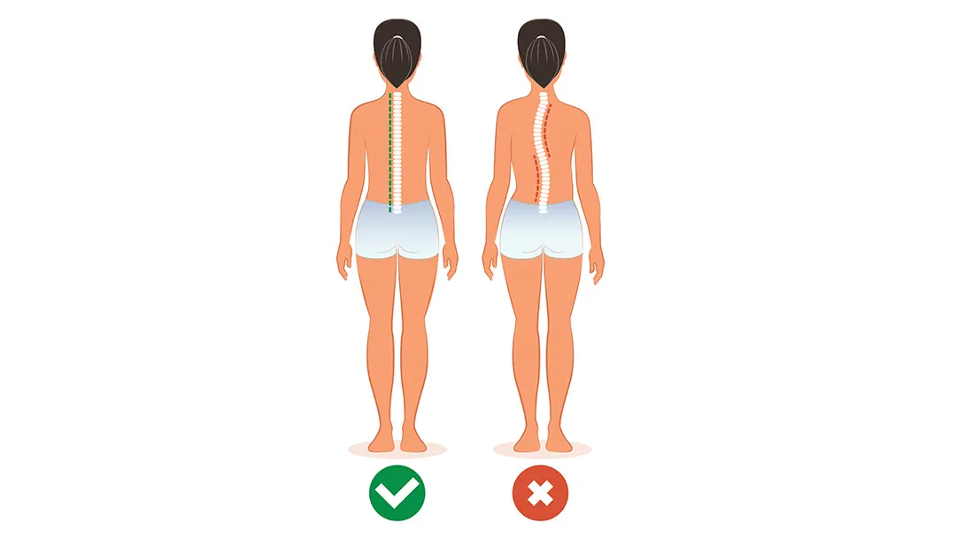 Scoliosis