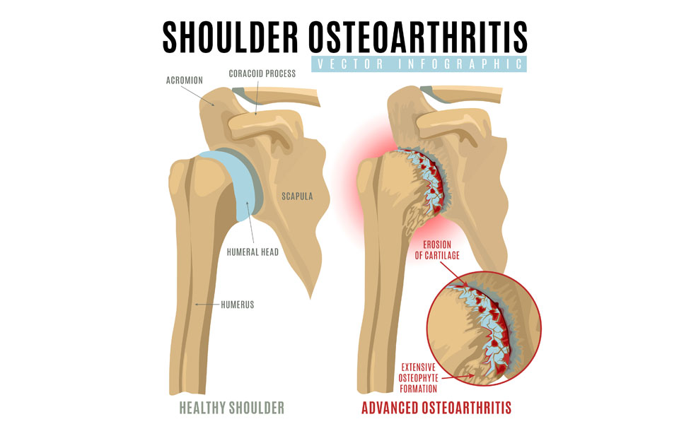 osteoarthritis in the shoulder joint.