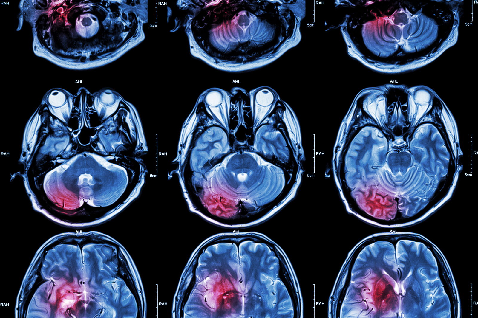 CT scan and MRI images showing brain injury