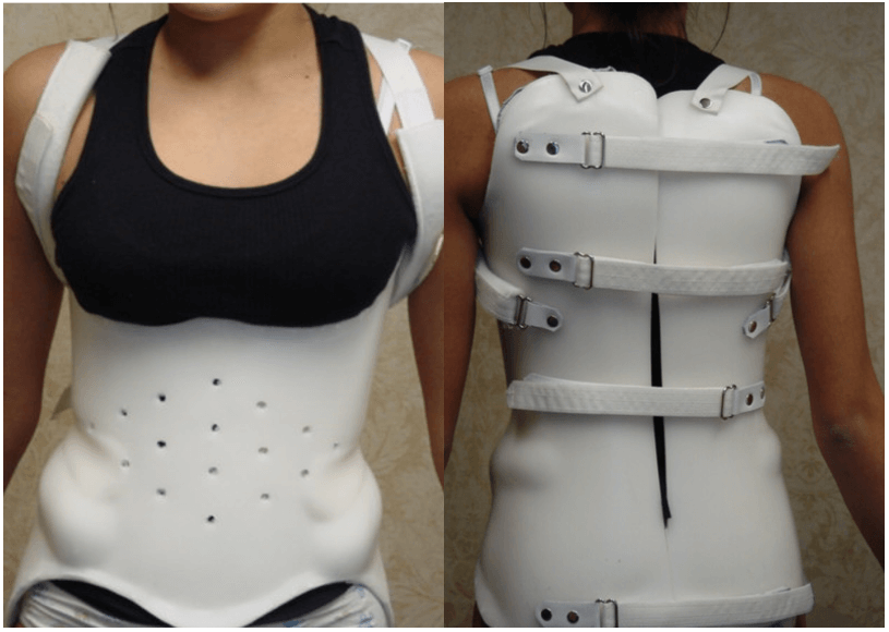 brace used for scoliosis treatment