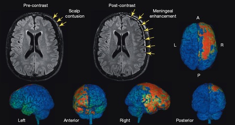 impact of a concussion on the brain