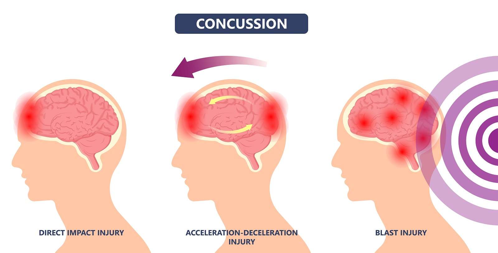 Types of a concussion