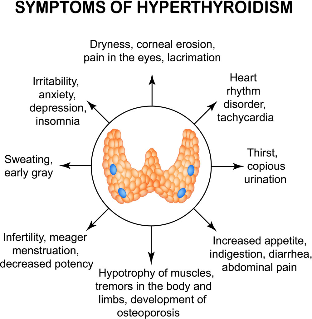 hyperthyroidism