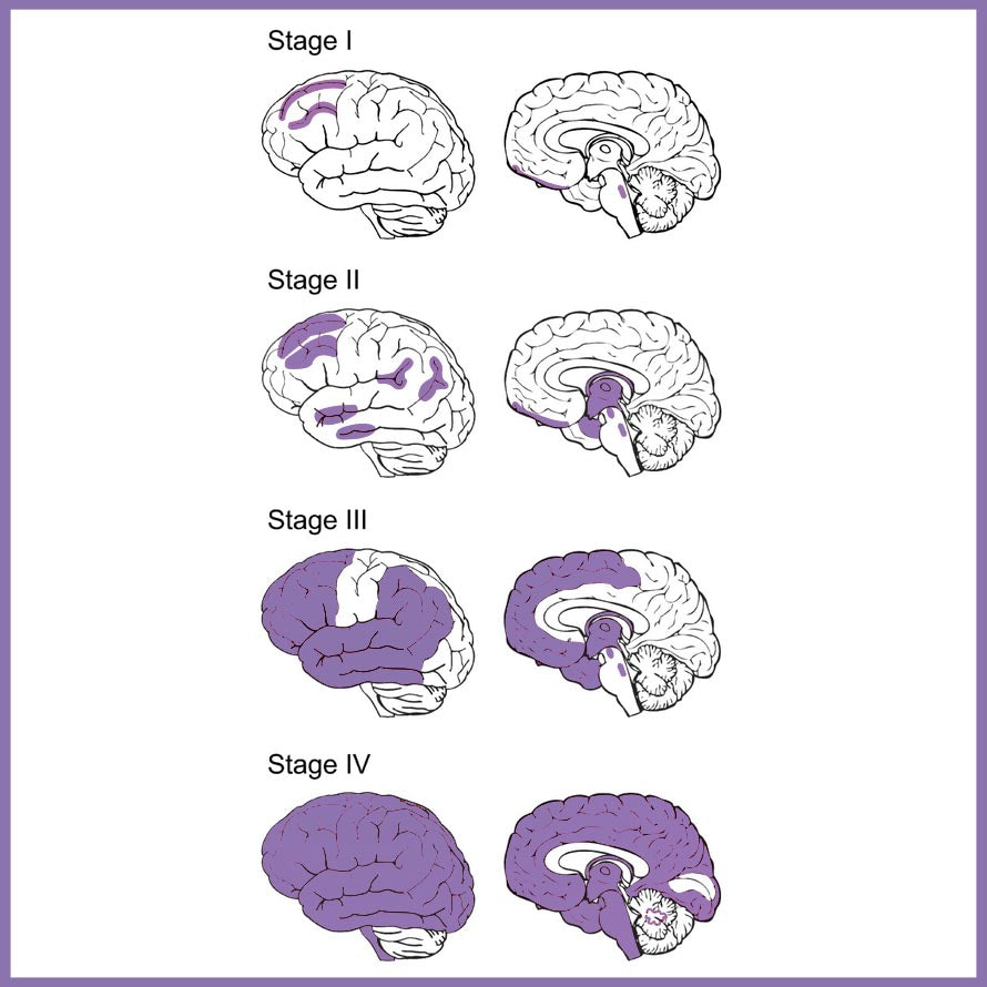 Chronic Traumatic Encephalopathy Stages