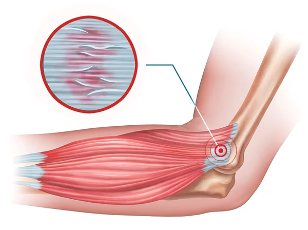 overuse injuries 