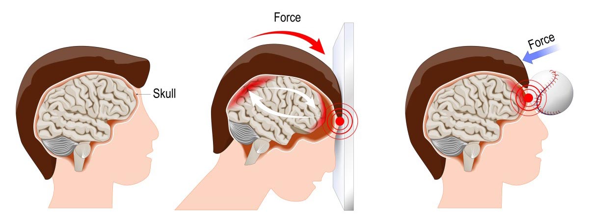 mpact of a blow to the head causing a concussion