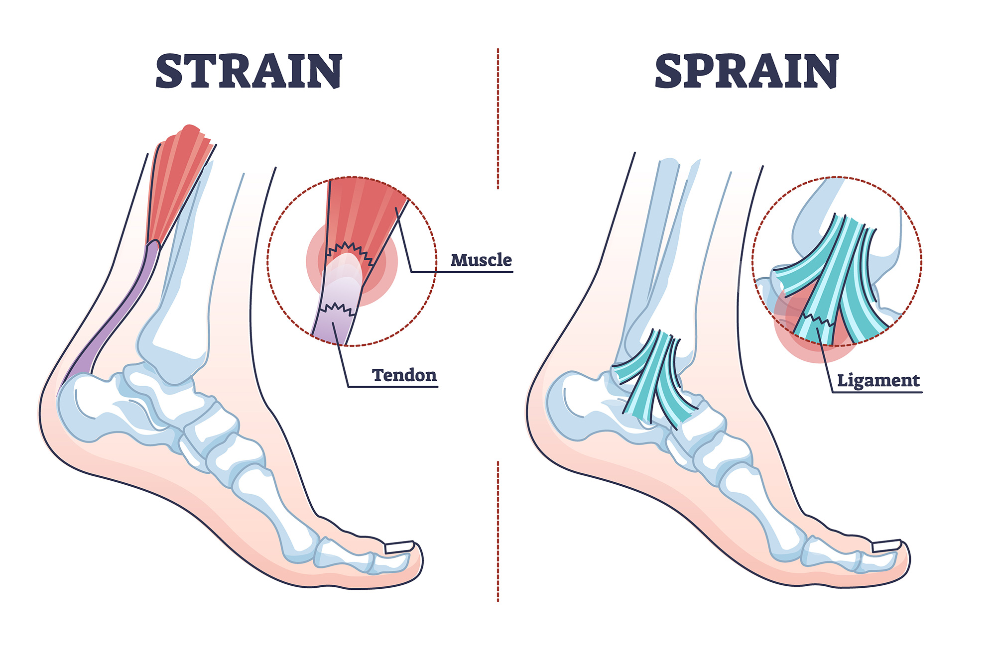 differences between sprains and strains
