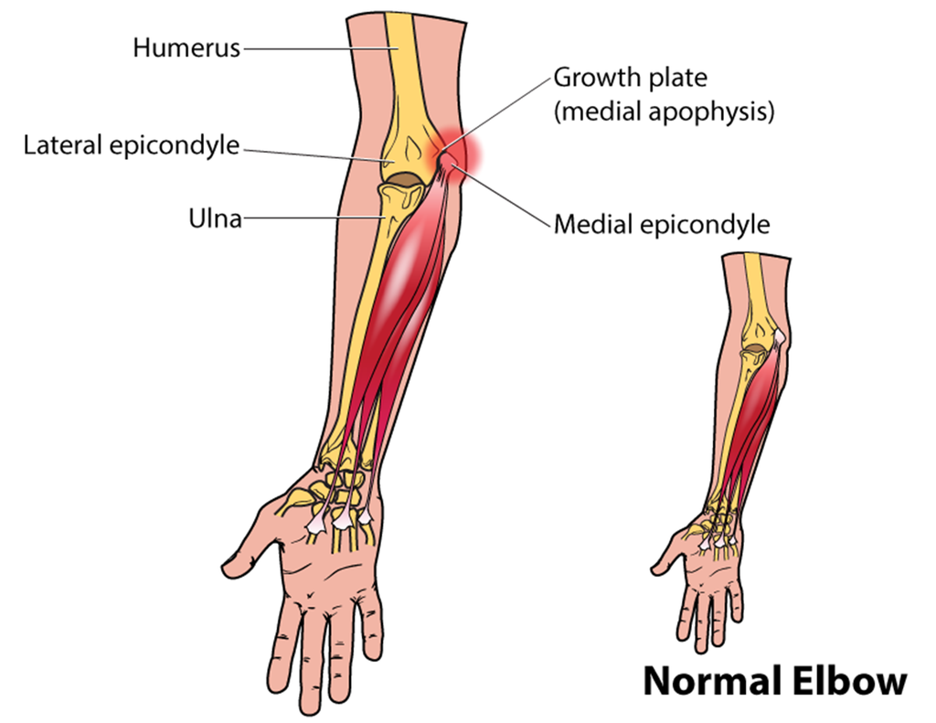 the area most affected by Little League Elbow