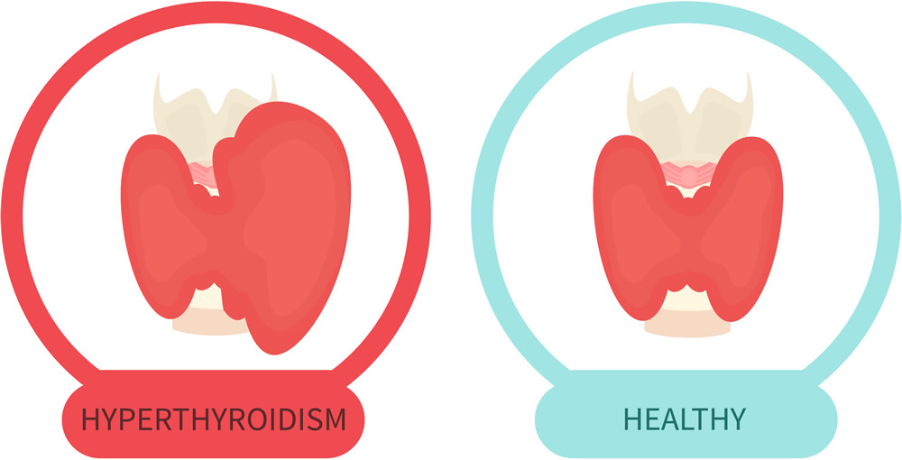 Healthy vs unhealthy thyroid