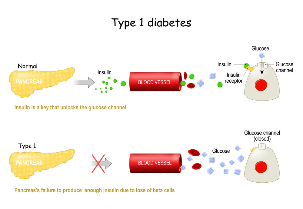 type 1 diabetes