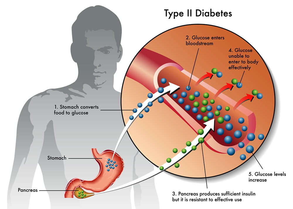 type 2 diabetes