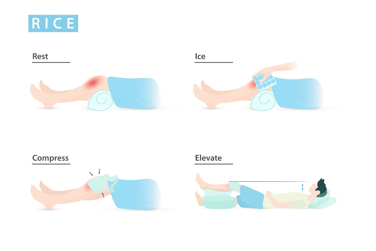 R.I.C.E. method for treating sprains